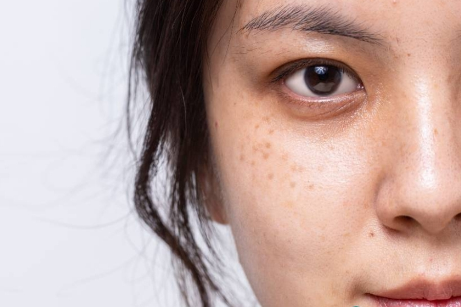 Nguyên nhân và dấu hiệu nhận biết tàn nhang – Vì sao da bạn xuất hiện những đốm nâu nhỏ?