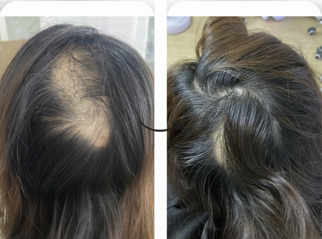 Hình ảnh bệnh nhân điều trị rụng tóc tại Phòng khám chuyên khoa da liễu Táo Đỏ