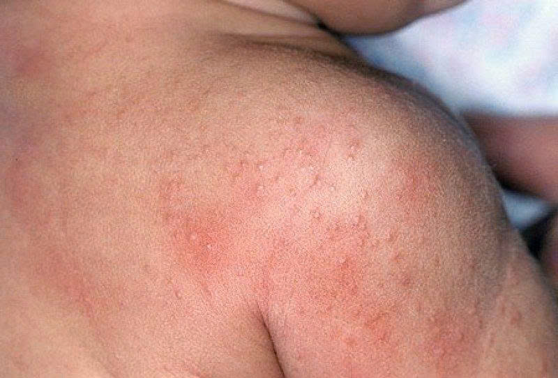 Viêm da cơ địa