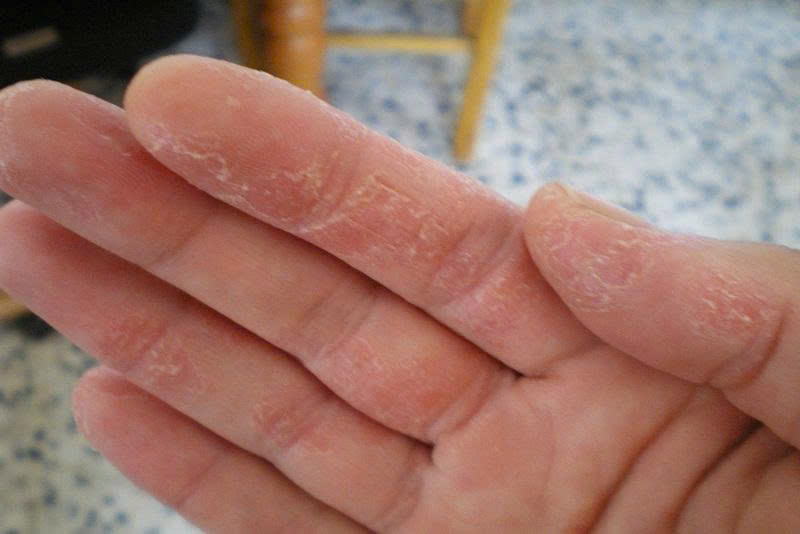 Viêm da cơ địa