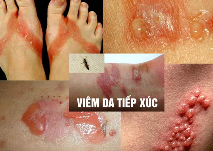 Viêm da tiếp xúc