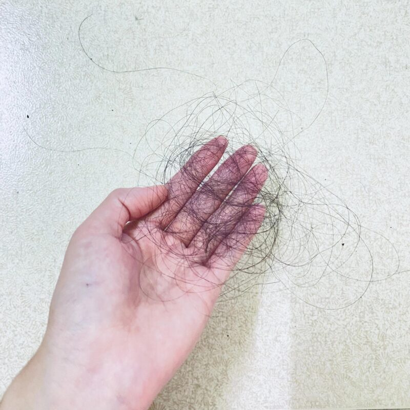 Rụng tóc 2