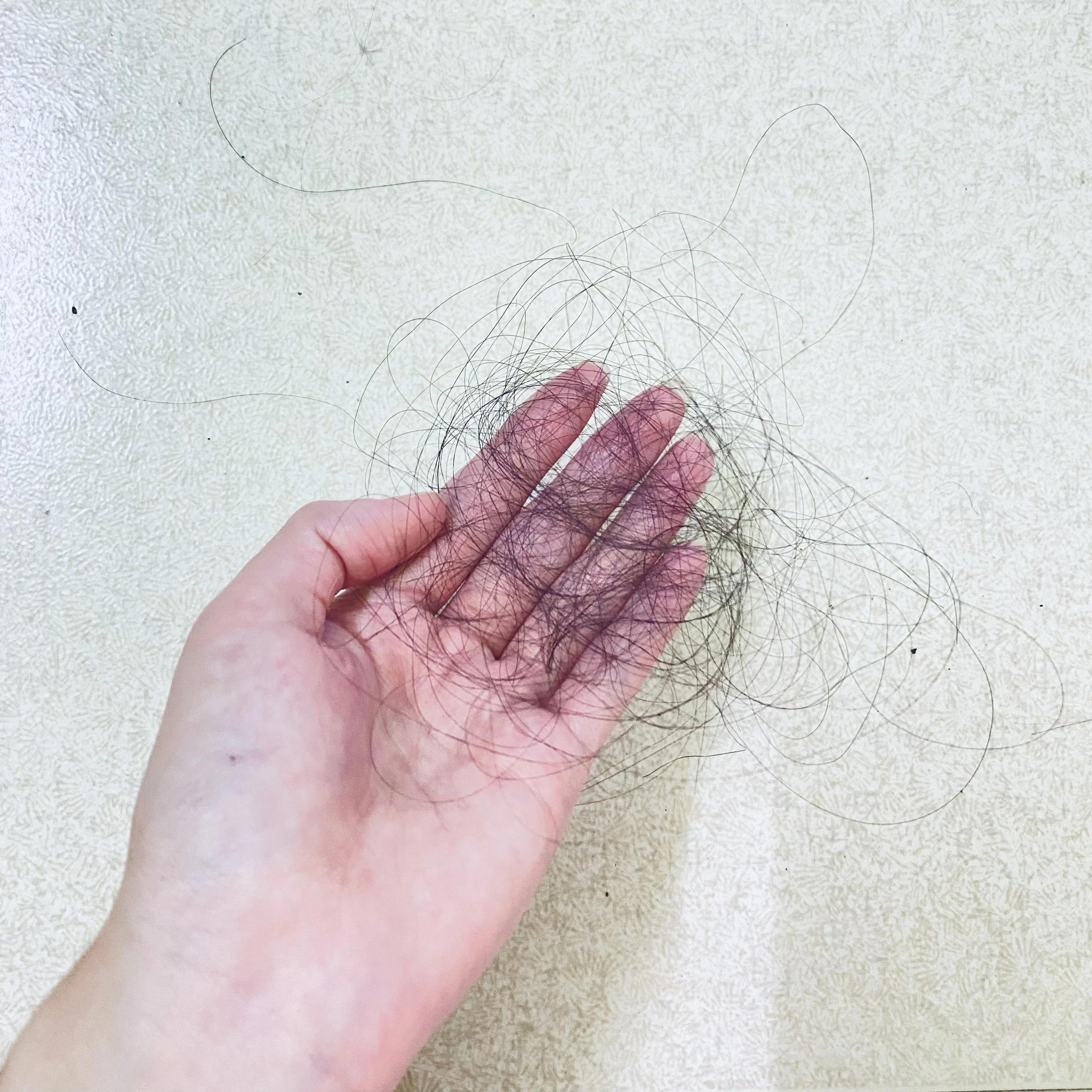 Rụng tóc 2