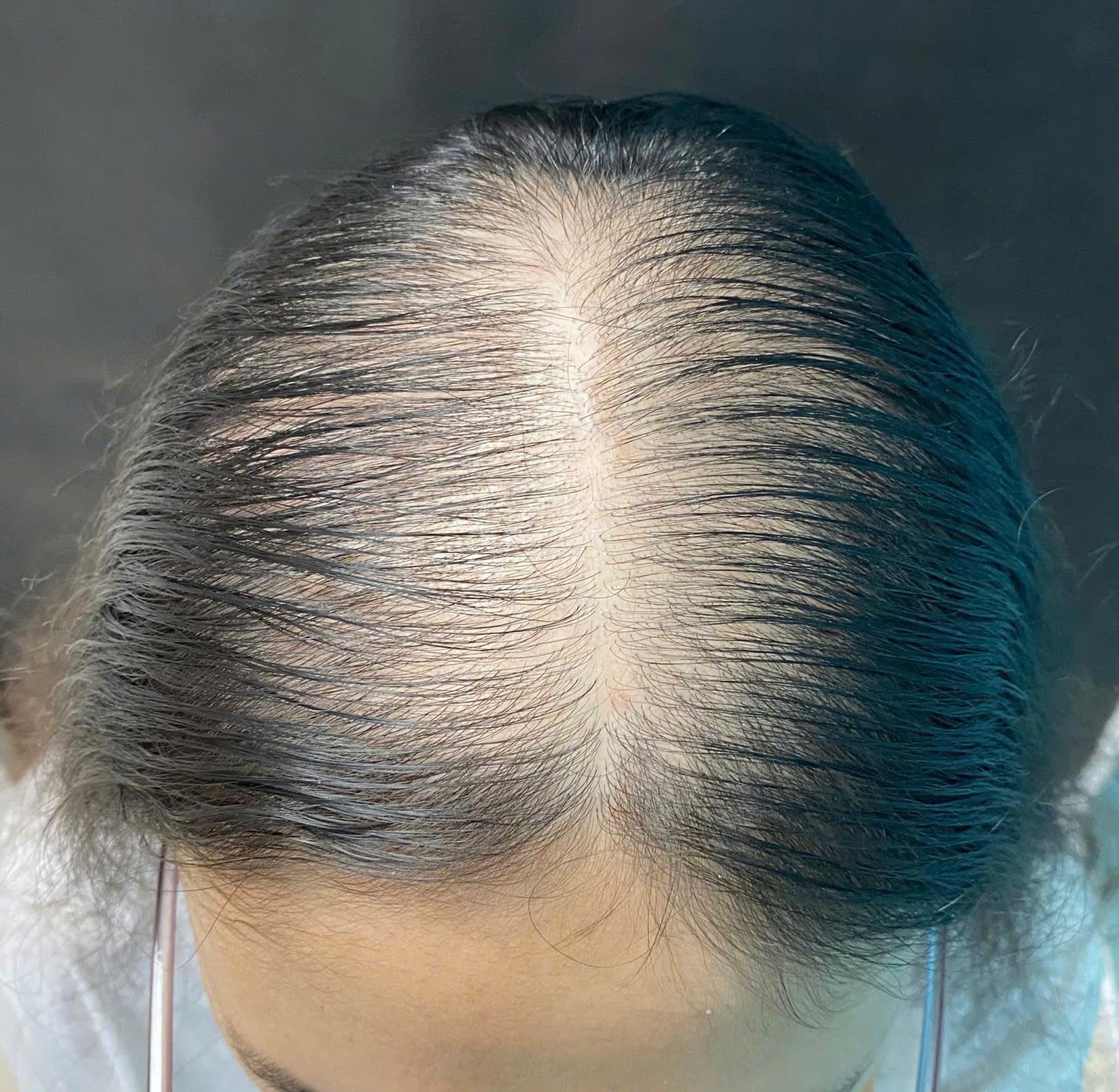 Rụng tóc