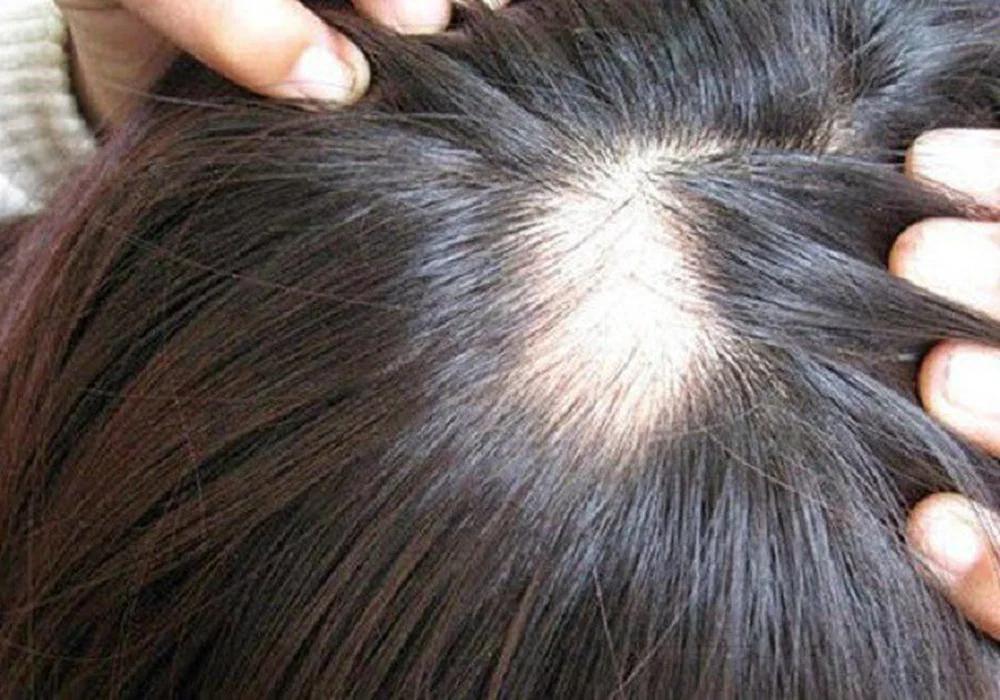 Rụng tóc