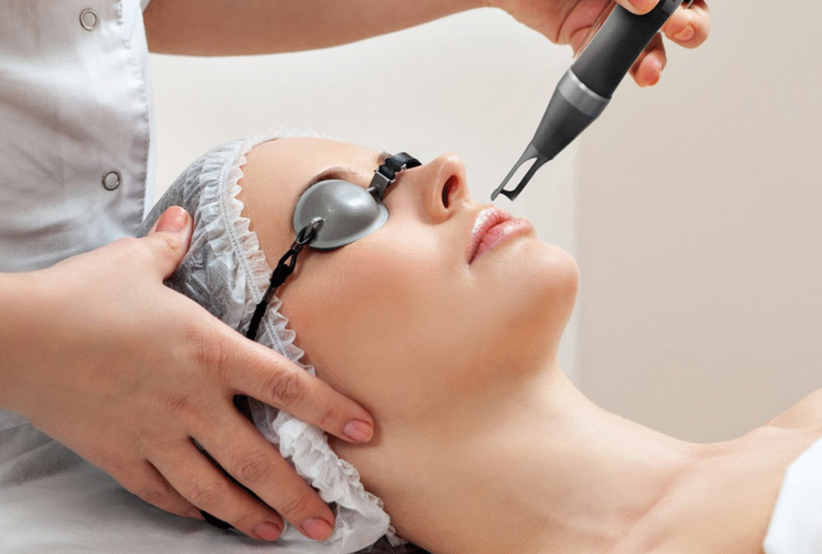 Laser trị mụn thâm sẹo