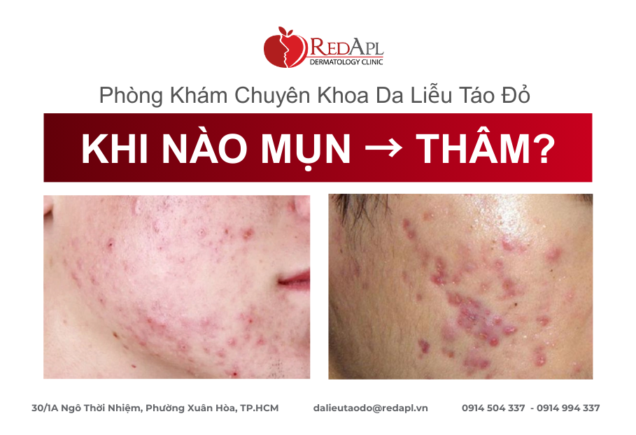 Khi nào mụn trở thành thâm
