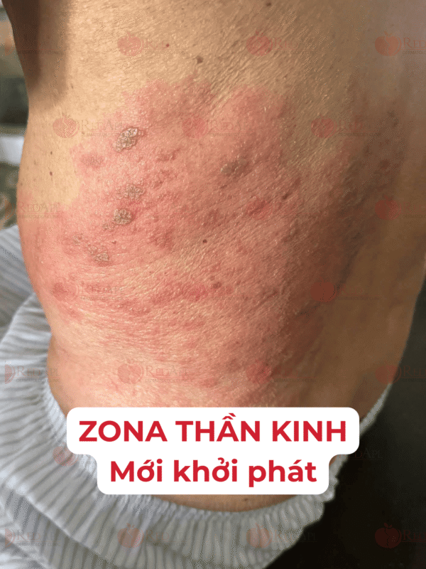Zona thần kinh giai đoạn mới khởi phát