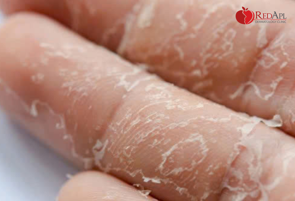 Thumbnail bài viết web_Thói quen lột da