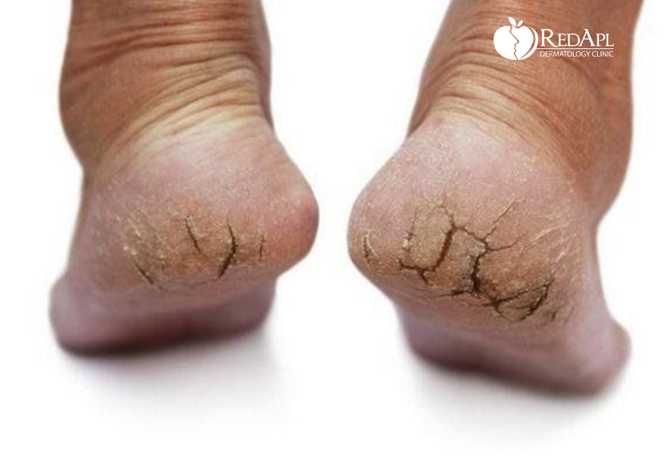 Nứt gót chân