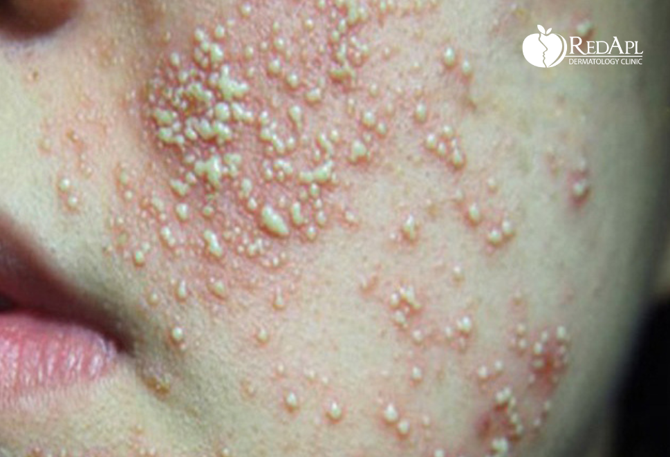 Biến chứng Corticoid