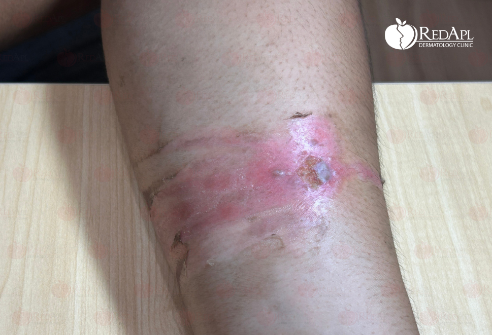 Tự trị mụn cóc bằng axit