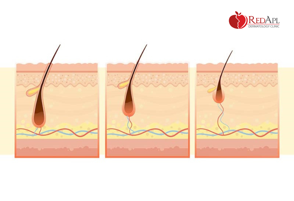 Tác nhân nang tóc