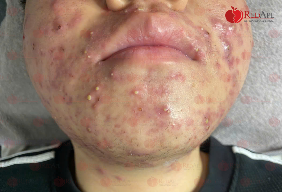 Da nhiễm corticoid