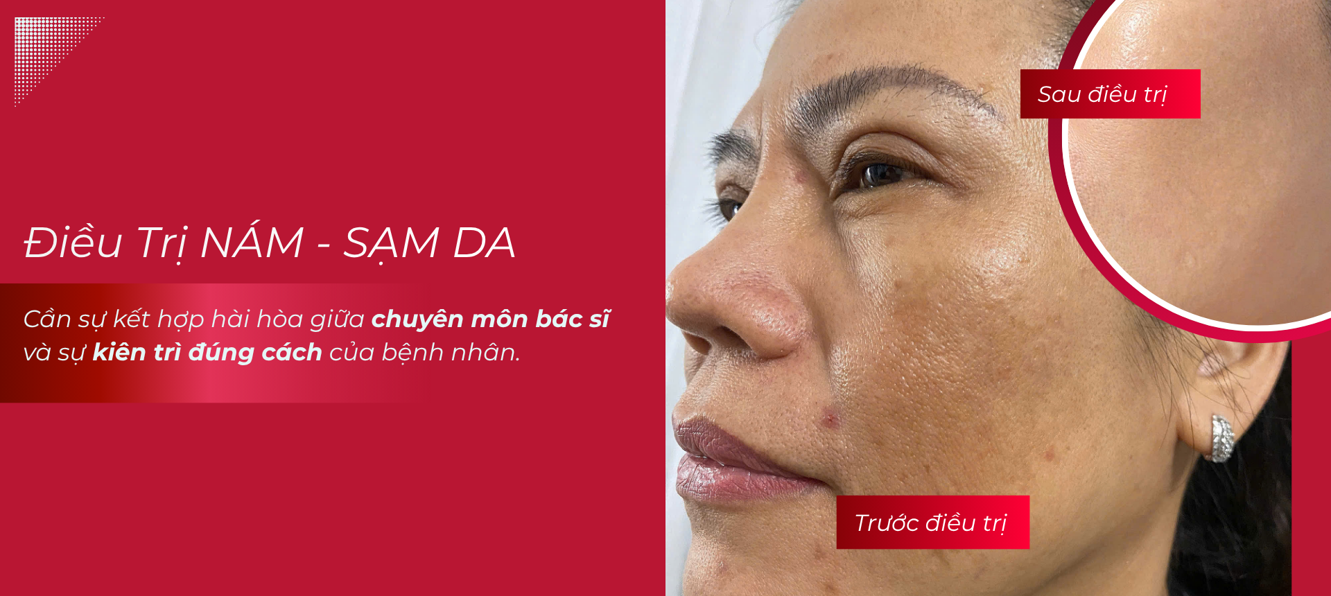 Trước sau nám sạm