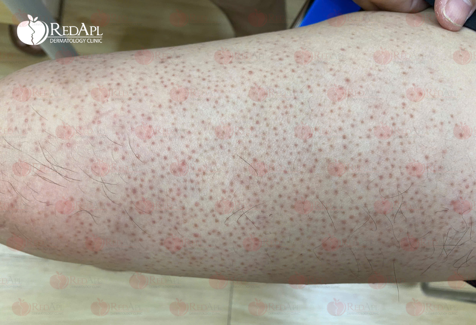 Dày sừng nang lông