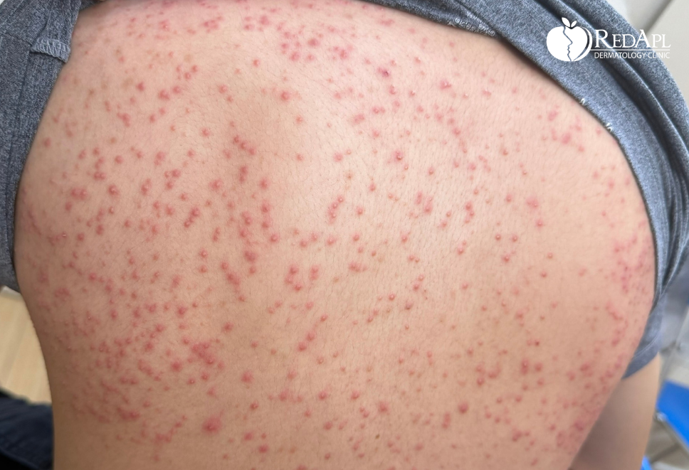 Mụn nấm là gì