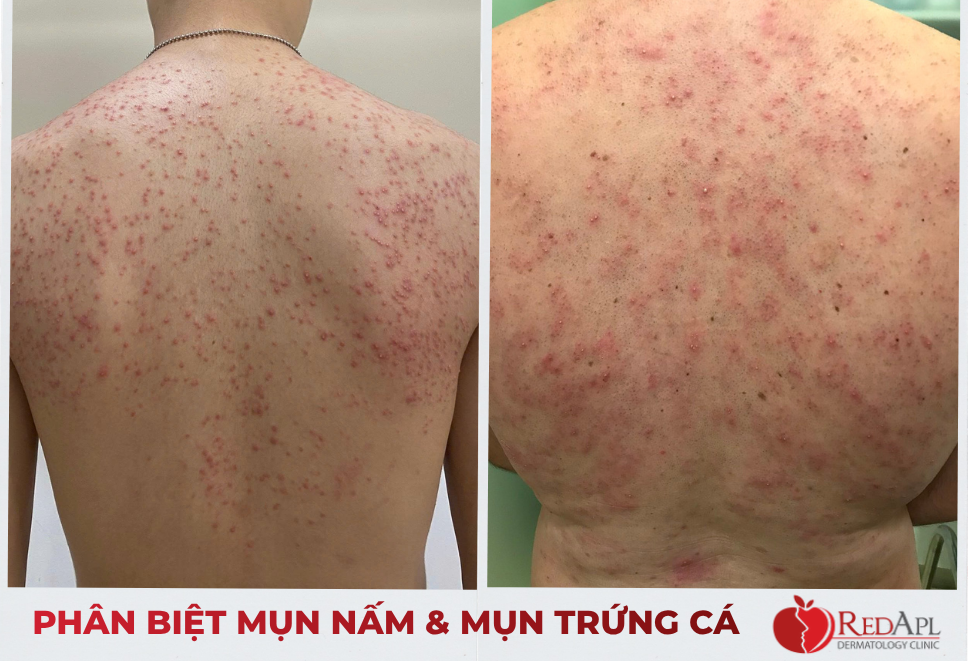 Mụn nấm và mụn trứng cá