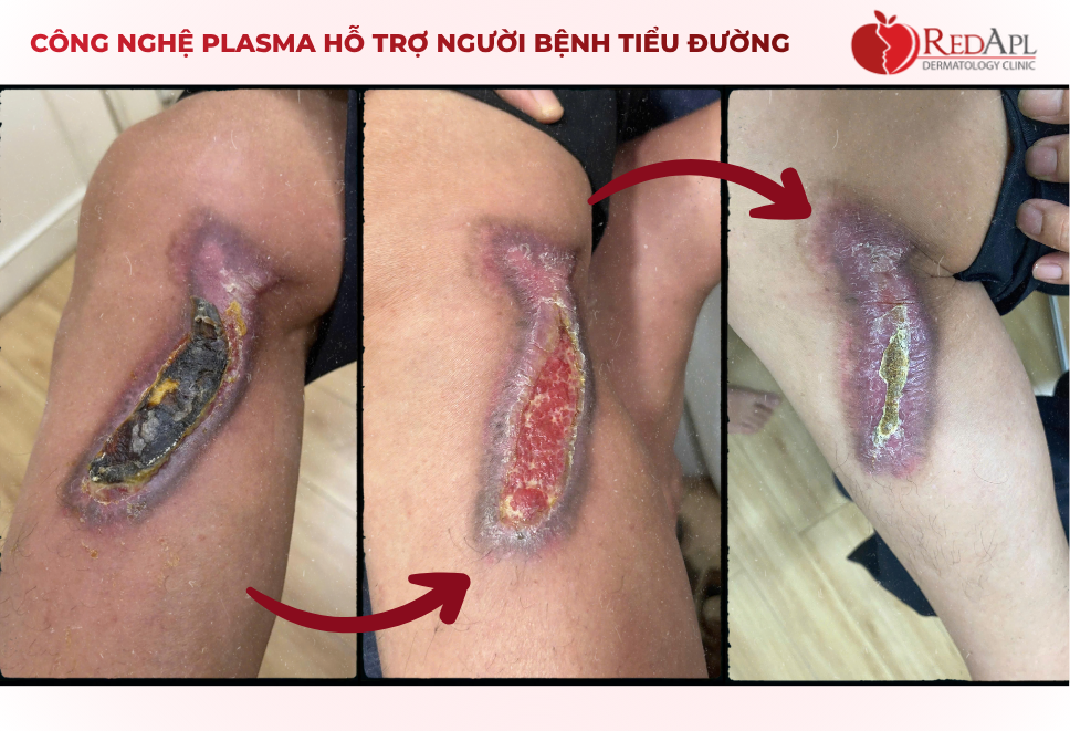 Công nghệ Plasma hỗ trợ người bệnh tiểu đường