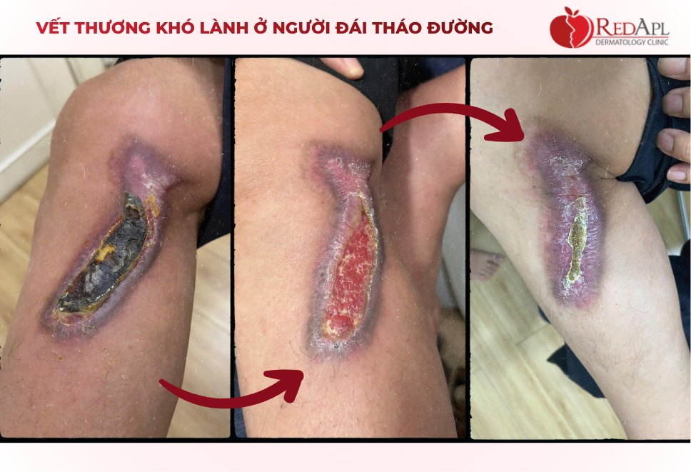 đái tháo đường