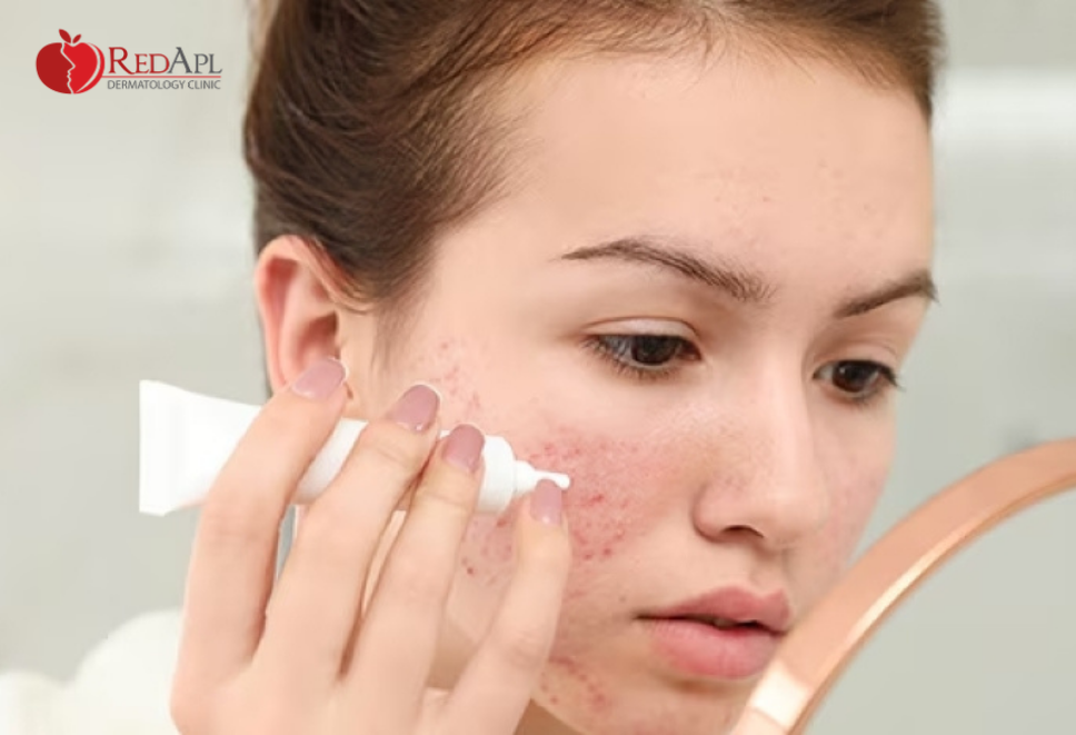 chống nắng trị mụn