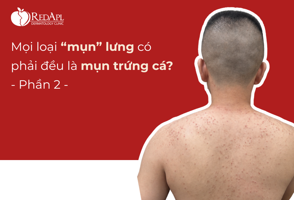 mụn lưng