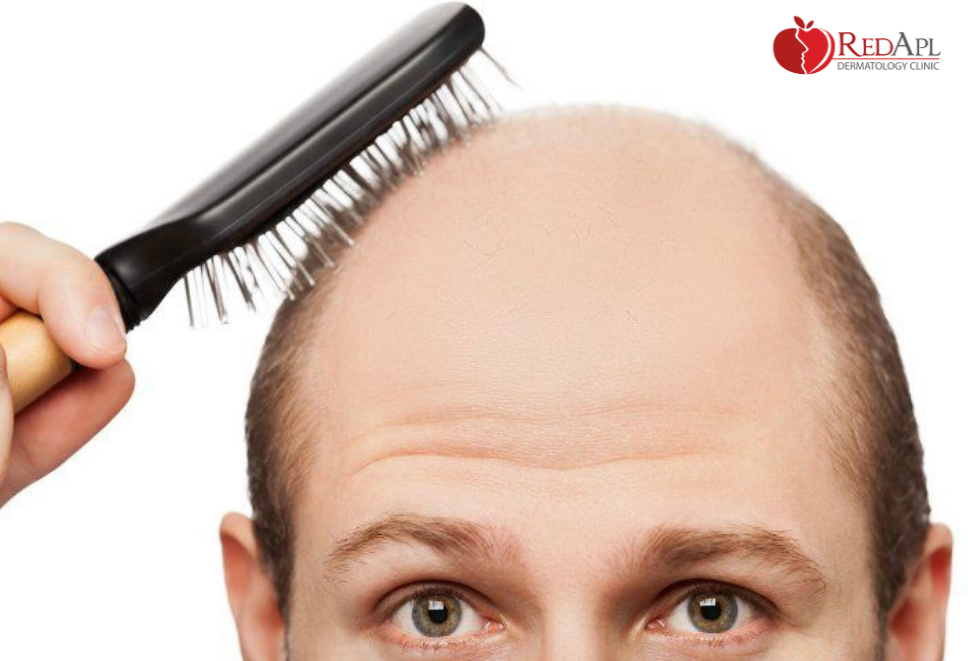 trị rụng tóc bao lâu