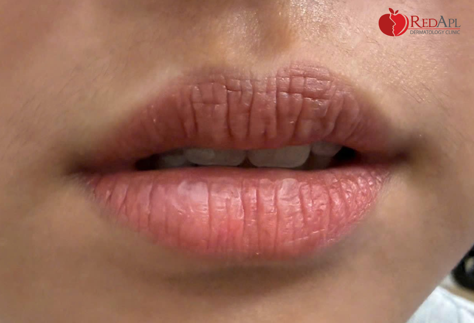 Môi Đột Ngột Sưng, Ngứa – Có Thể Bạn Đã Bị Dị Ứng