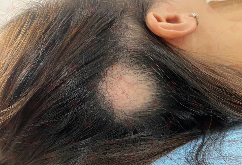 Rụng tóc từng mảng