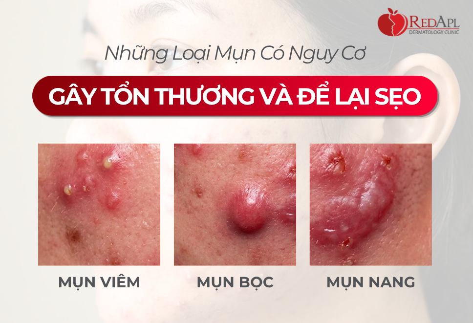 Các Loại Mụn Có Nguy Cơ Gây Tổn Thương Và Để Lại Sẹo Mụn