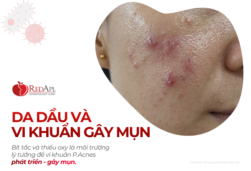 Da Dầu Và Vi Khuẩn Gây Mụn