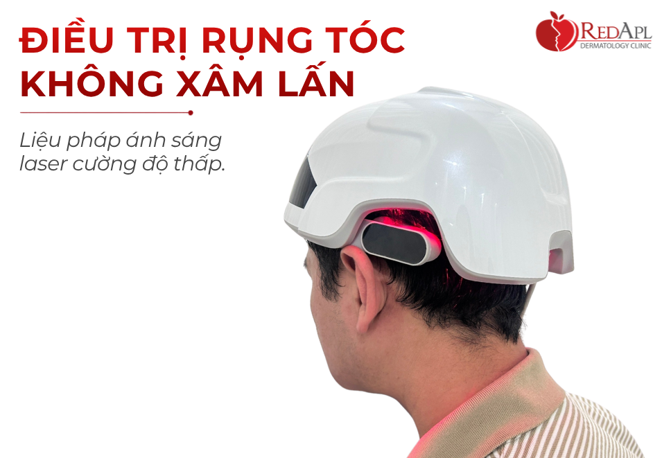 Điều Trị Rụng Tóc Không Xâm Lấn -  Liệu Pháp Ánh Sáng Laser Cường Độ Thấp