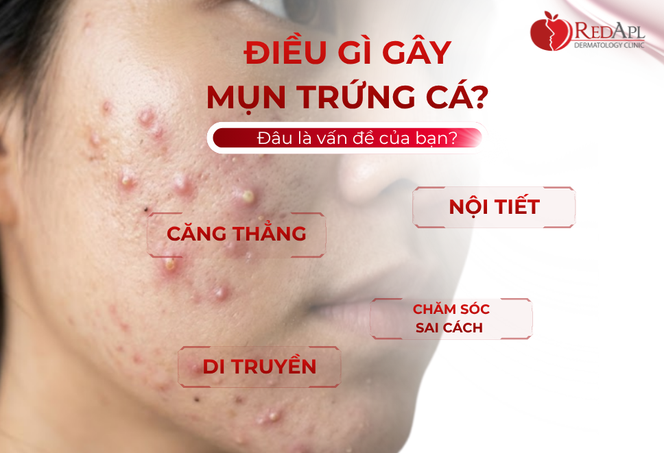 Điều Gì Gây Mụn Trứng Cá?