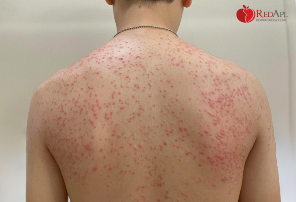 Ca điều trị mụn nấm tại Táo Đỏ