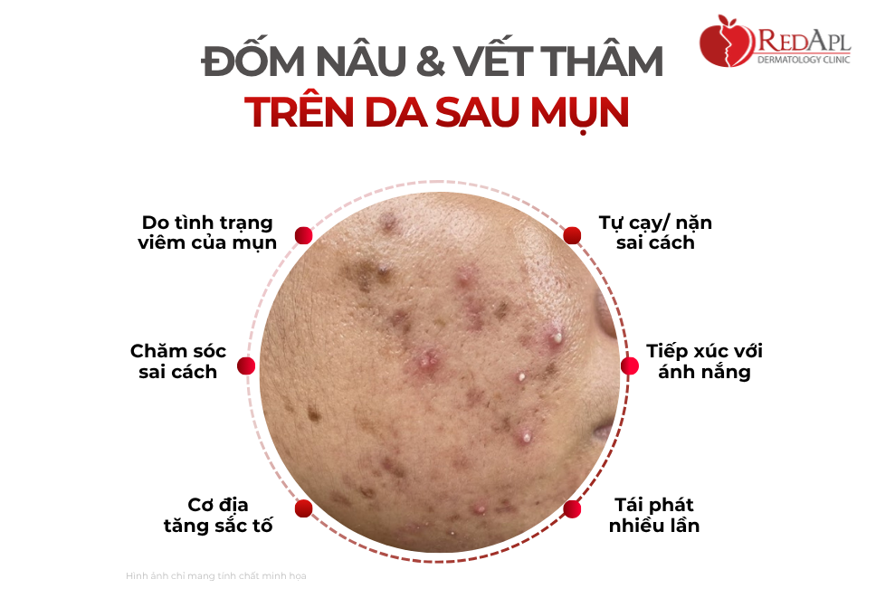 Đốm Nâu Và Vết Thâm Trên Da Sau Mụn