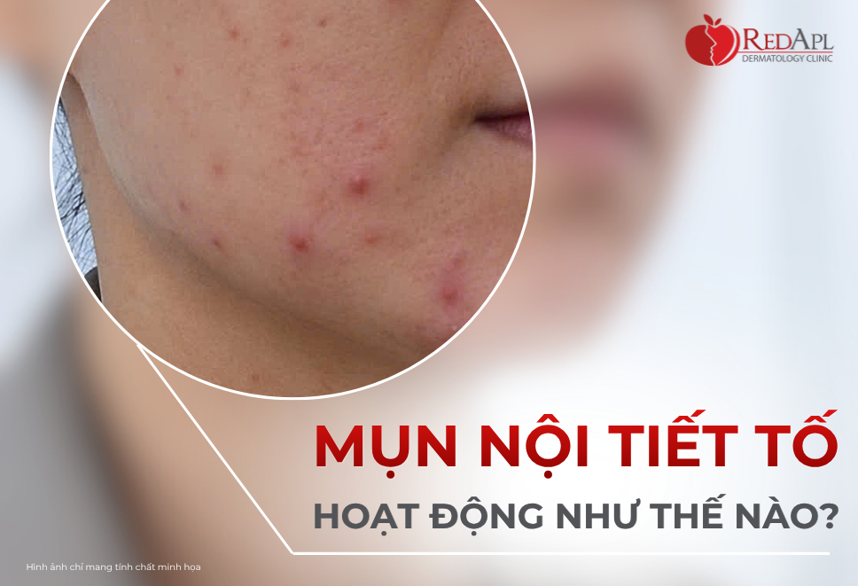 Mụn Do Nội Tiết Tố Hoạt Động Thế Nào