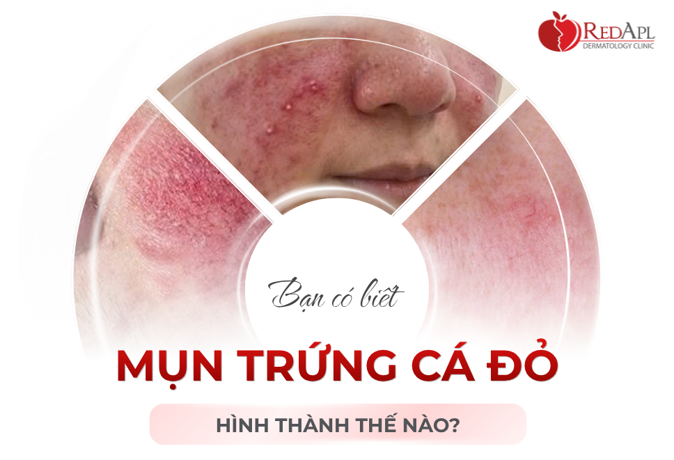 Mụn Trứng Cá Mẩn Đỏ Hình Thành Thế Nào?