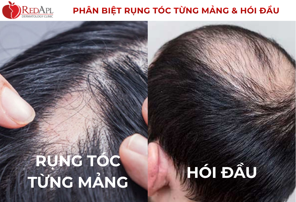 Phân Biệt Rụng Tóc Từng Mảng Và Hói Đầu
