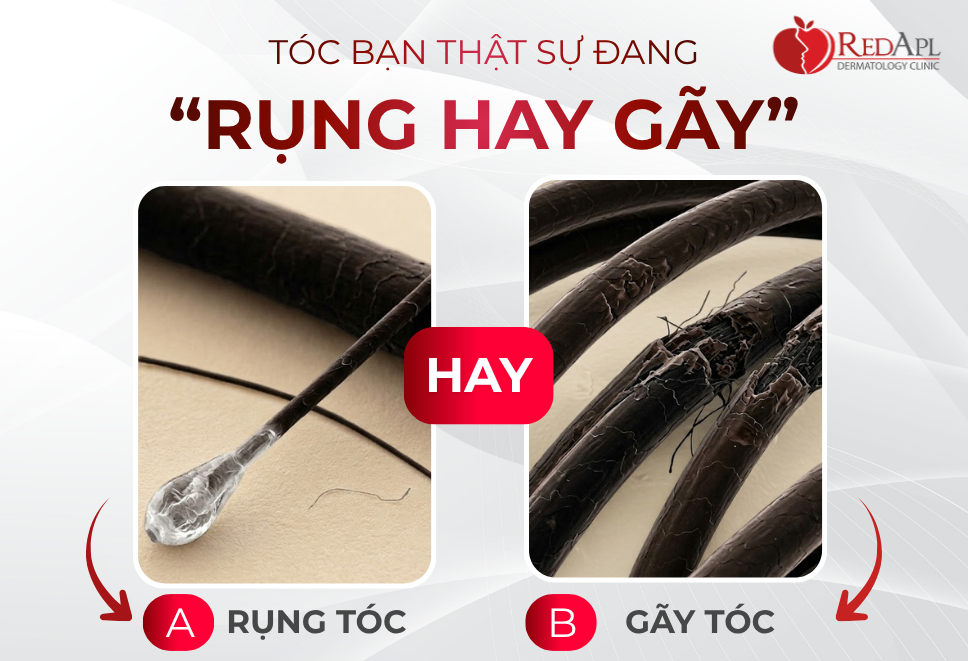 Tóc Của Bạn “Bị Gãy” Hay “Bị Rụng”?