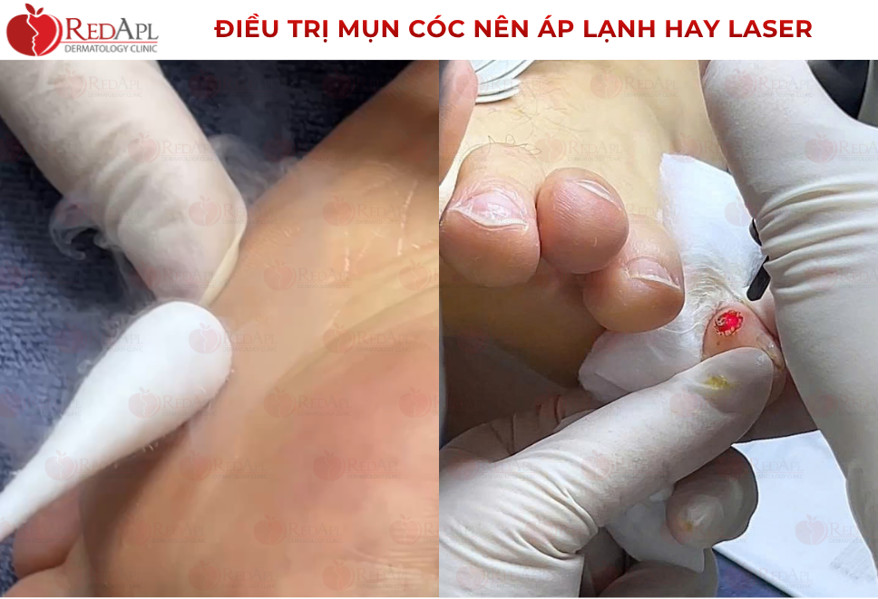 Điều Trị Mụn Cóc: Nên Áp Lạnh Hay Laser?