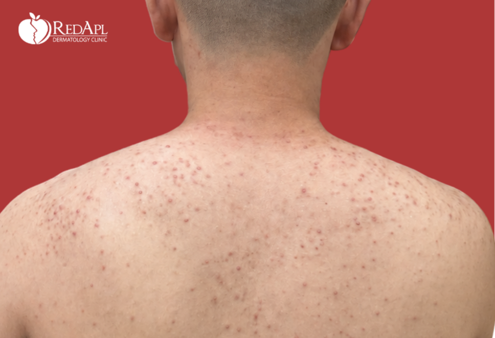 Trị mụn lưng hoài không hết